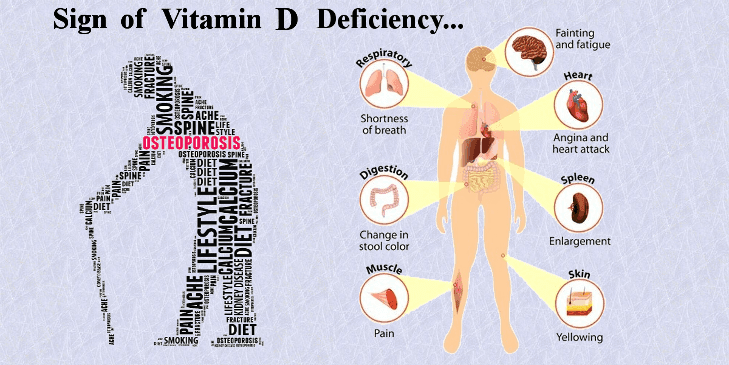 vitamin d deficiency